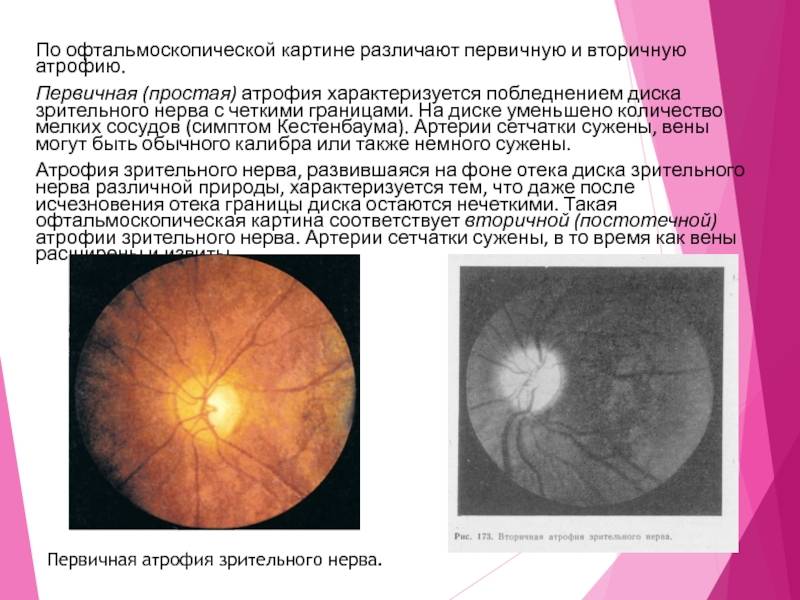 Частичная атрофия зрительного нерва: лечение