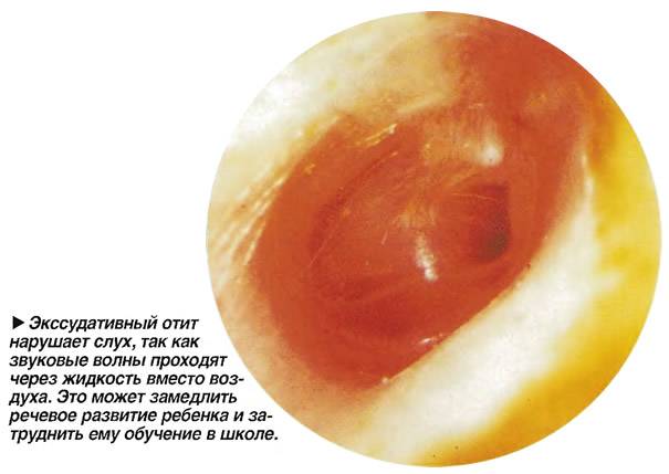 Хронический гнойный отит среднего уха: симптомы, лечение у взрослых, виды