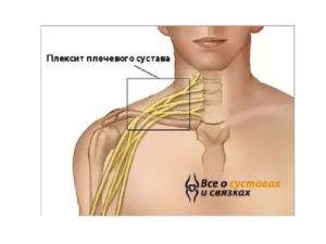 Плексит плечевого сустава: симптомы, лечение (медикаменты, упражнения, народные и др средствами)
