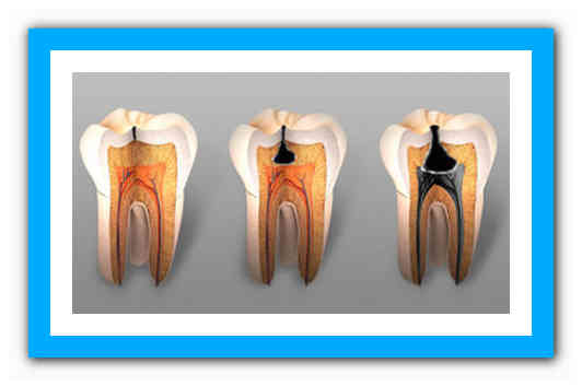 Депульпирование зуба: что это такое, показания и последствия. зачем и как депульпировать зубы