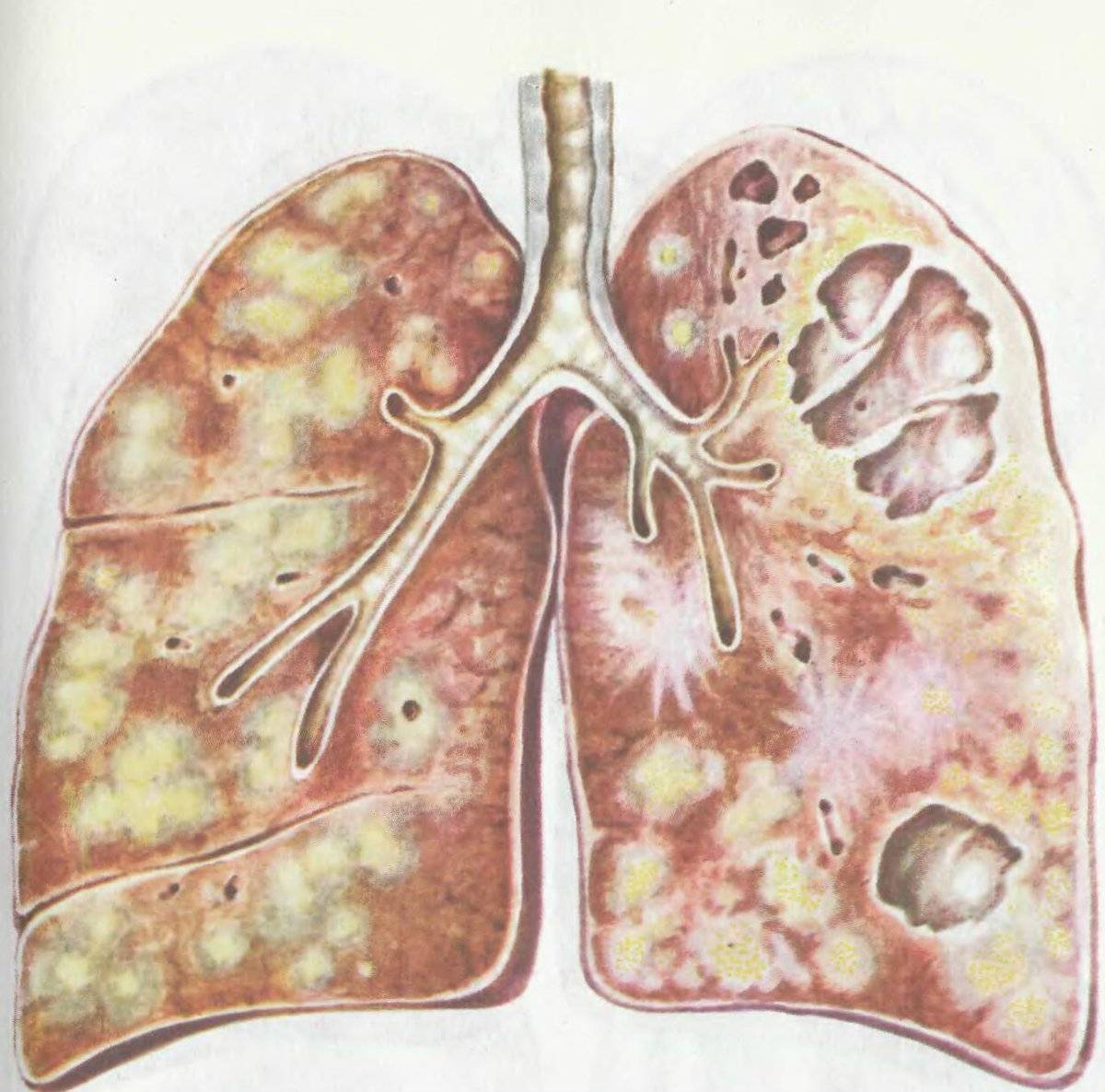 О первых признаках туберкулеза и симптомах у взрослых на начальных стадиях болезни — стоптубик