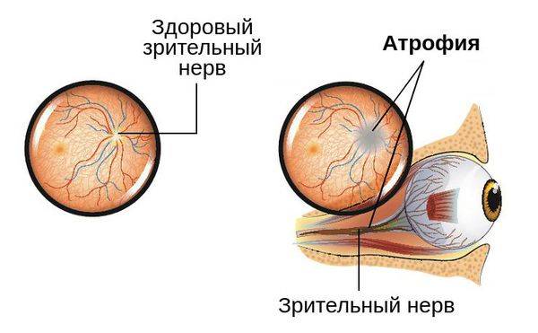 Атрофия зрительного нерва: из-за чего возникает, как проявляется и лечится