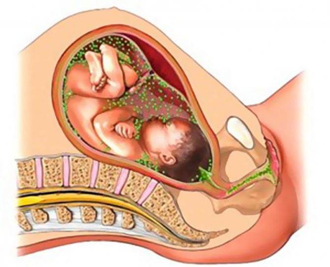 Пневмония у новорожденных после кесарева: какие причины, последствия, сколько лечить, срок восстановления после внутриутробной
