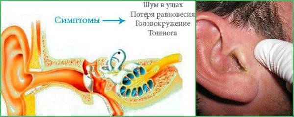 Заложенность в ухе после отита: лечение, упражнения