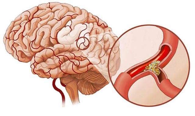 Атеросклероз сосудов головного мозга у пожилых: симптомы и лечение, диагностика