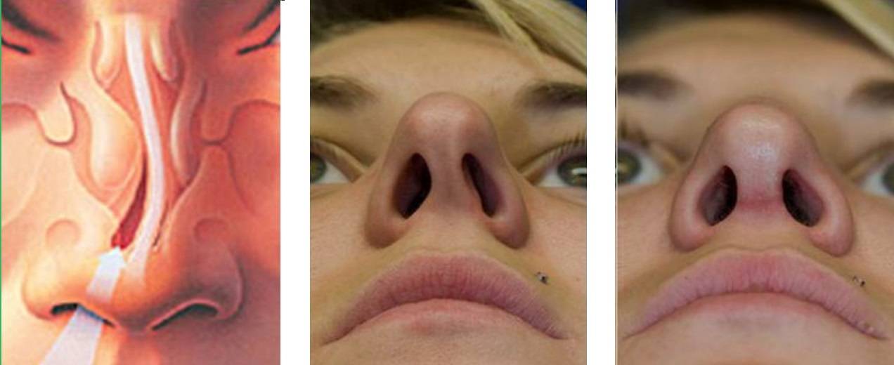 Эндоскопическая септопластика носовой перегородки - фото, цена и отзывы