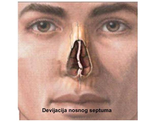 Искривление носовой перегородки: причины и лечение операцией и без