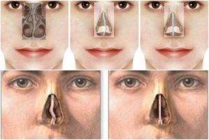 Врожденные аномалии [пороки развития] носа