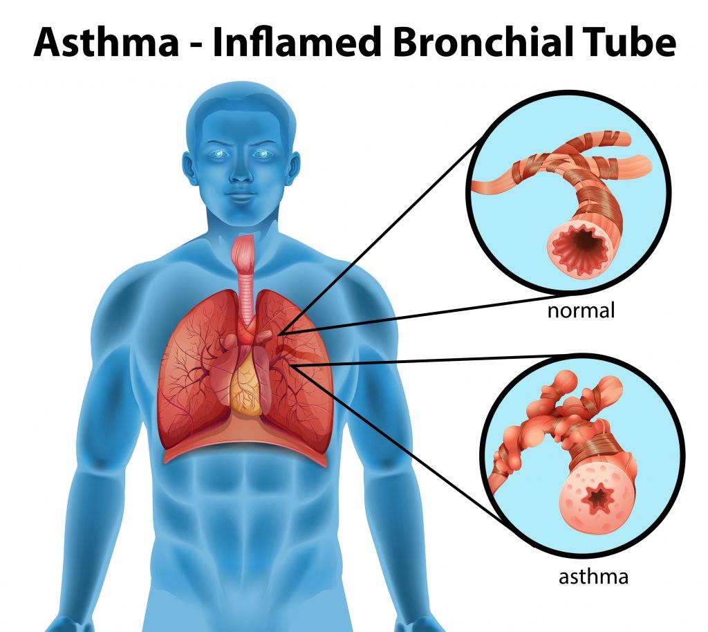 Особенности развития бронхиальной астмы у подростков, симптомы и лечение
