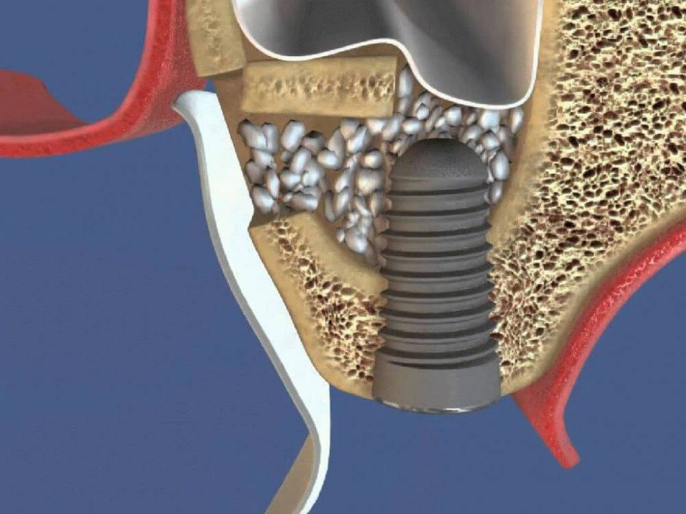Что такое синус-лифтинг при имплантации зубов и как проводят процедуры одновременно