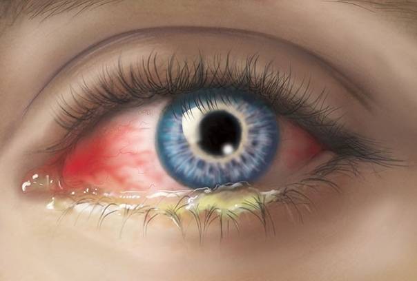 Вирусный конъюнктивит глаз — лечение у взрослых с помощью капель, мазей и других препаратов