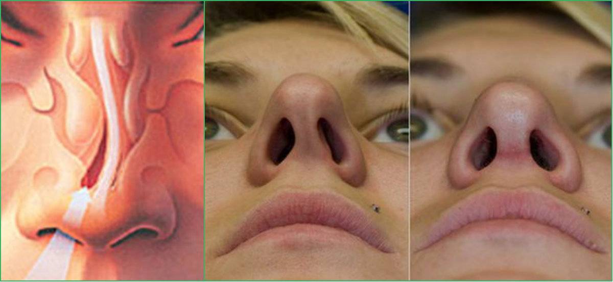 Искривление перегородки носа – последствия и лечение. операция при искривлении носовой перегородки.