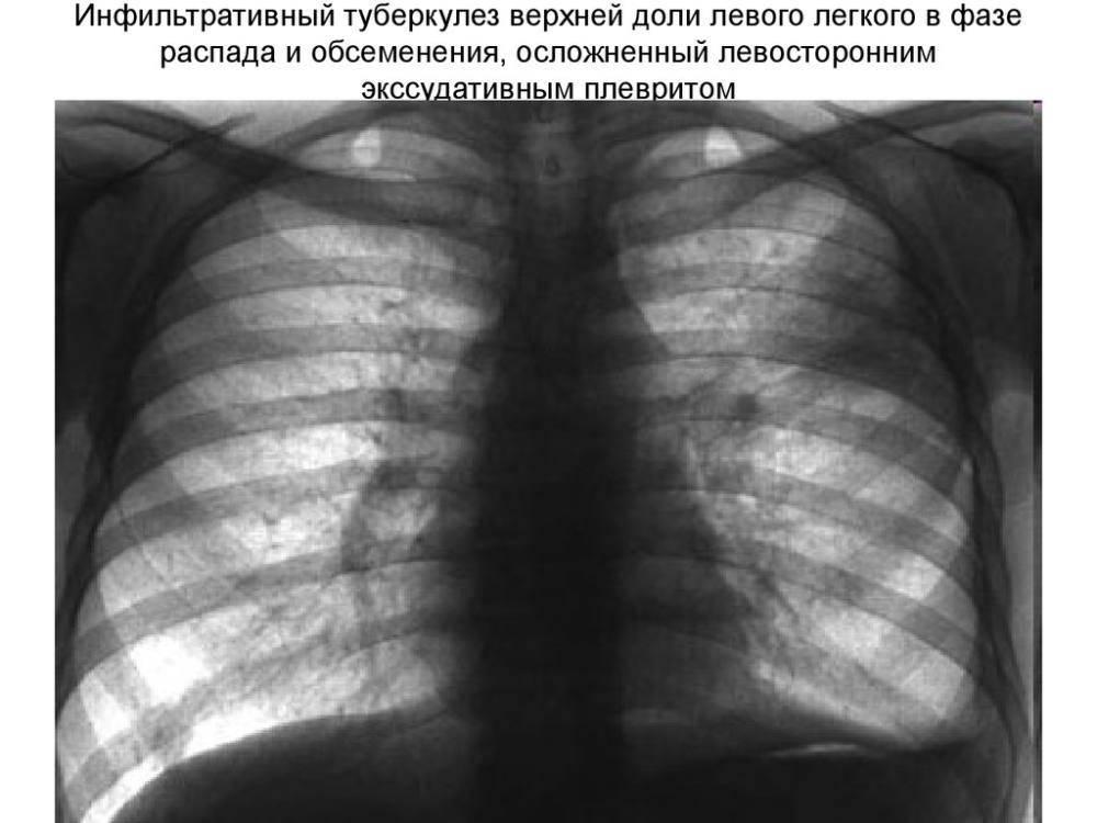 Очаговый туберкулез легких: что это такое, заразен или нет при контакте для окружающих, лечение, дифференциальная диагностика, рентген и клинические рекомендации