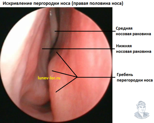 Последствия искривления носовой перегородки; лечение. симптомы искривления перегородки носа и операция при ней искривление носовой перегородки шифр по мкб 10