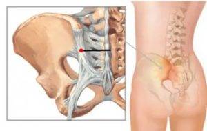 Крестцово-подвздошный сустав: анатомия и заболевания сочленения