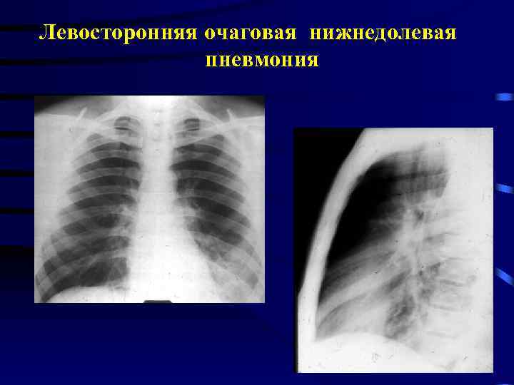 Левосторонняя нижнедолевая пневмония: основные причины, симптомы, разновидности воспаления, диагностика, способы лечения, помощь народных средств