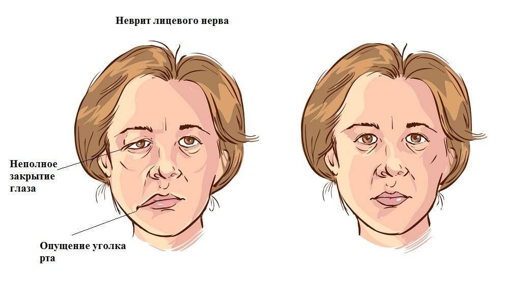 Как снять симптомы и острую боль: способы лечения невралгии лицевого тройничного нерва