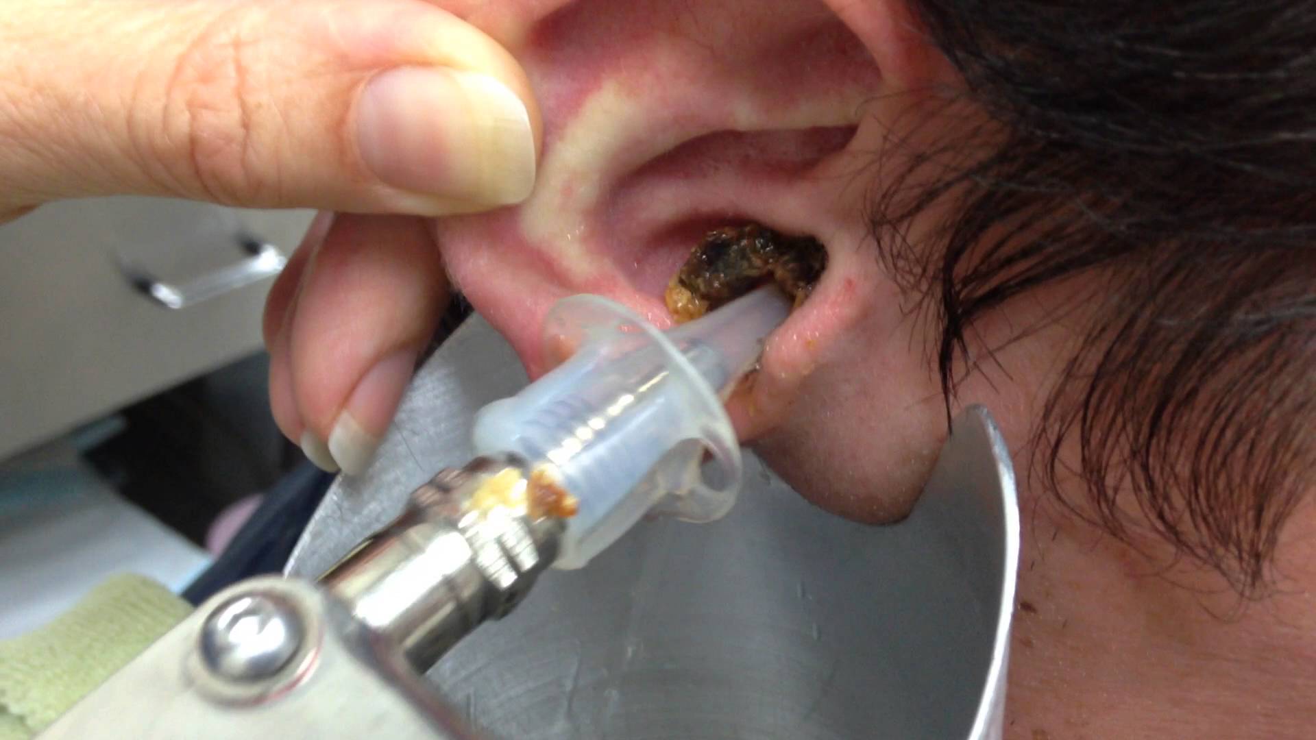 Серная пробка в ухе: как возникает, симптомы, методы удаления безопасно