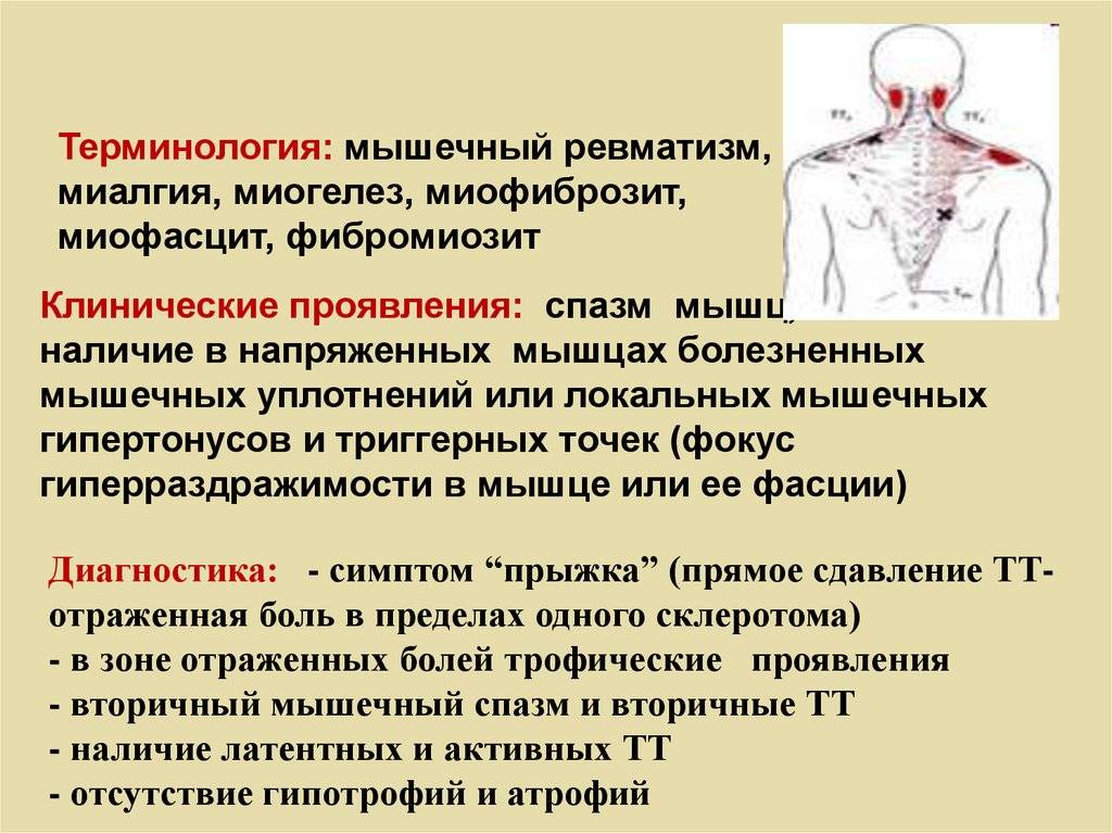 Что такое миалгия симптомы причины и лечение миалгии - медицинский портал schoolmedcentre.ru