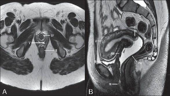 Кт в гинекологии для исследования органов малого таза у женщин — что показывает томография?