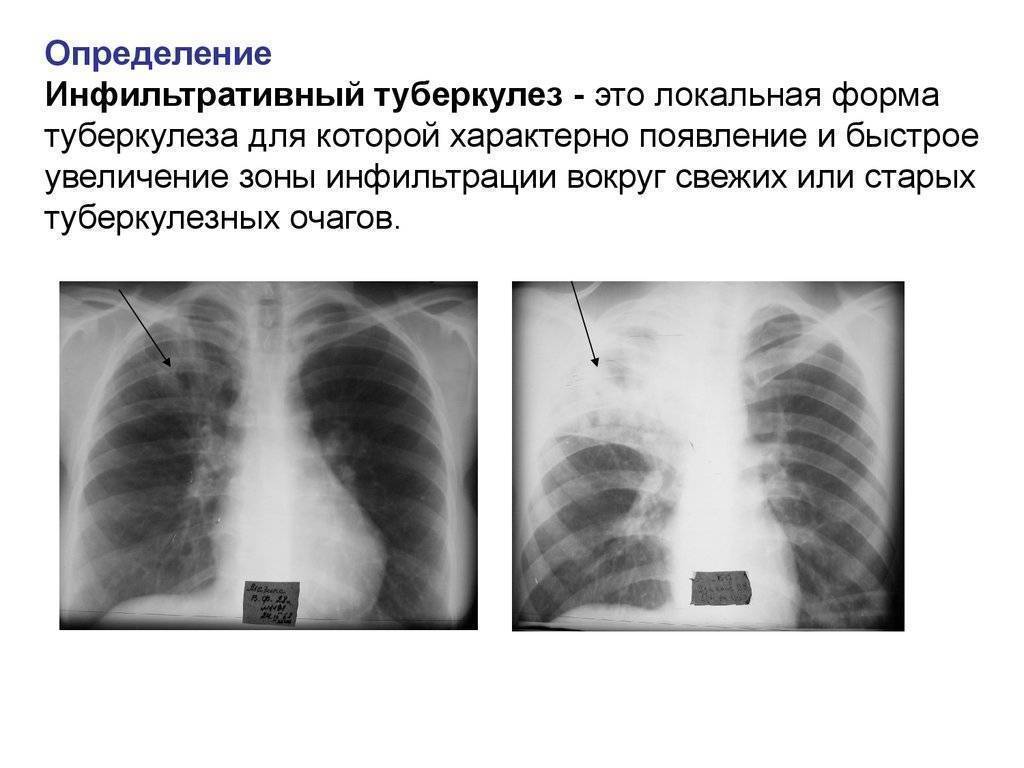 Очаговый туберкулез легких: заразен или нет, лечение в фазе инфильтрации, двухсторонний рентген, симптомы распада верхней доли правого легкого