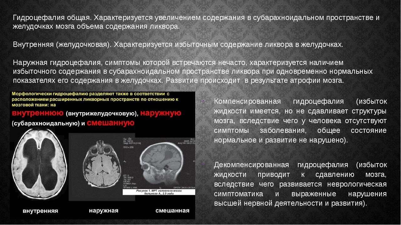 Гидроцефалия (водянка головного мозга): что это такое, симптомы заболевания у взрослых, методы лечения