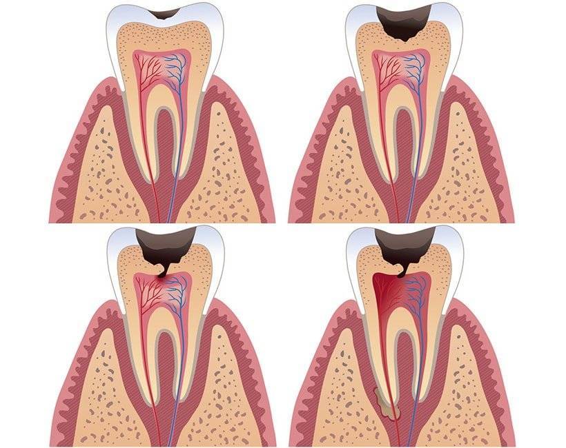 Депульпирование зуба перед протезированием - дезинфекция, подготовка под коронку