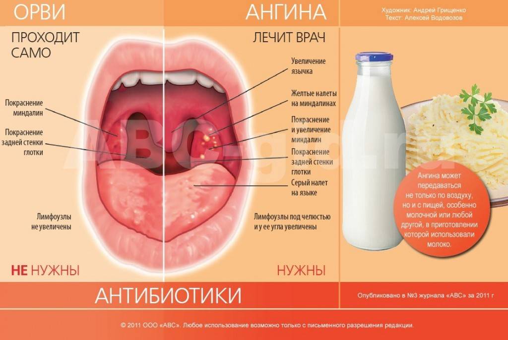 Чем и как лечить ангину у ребёнка в 2-3 года - проверенные средства pulmono.ru
чем и как лечить ангину у ребёнка в 2-3 года - проверенные средства