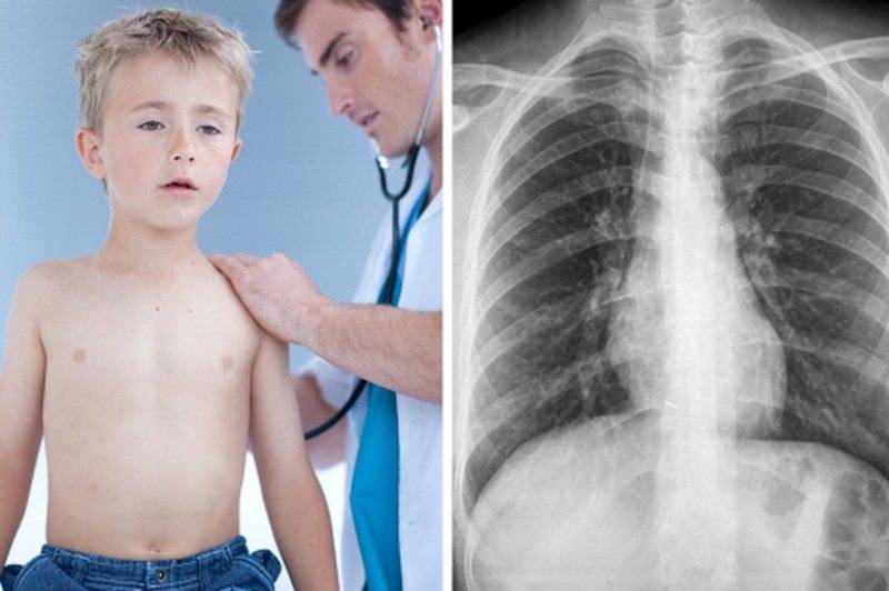 Насколько заразна пневмония для окружающих детей? как уберечь ребенка?