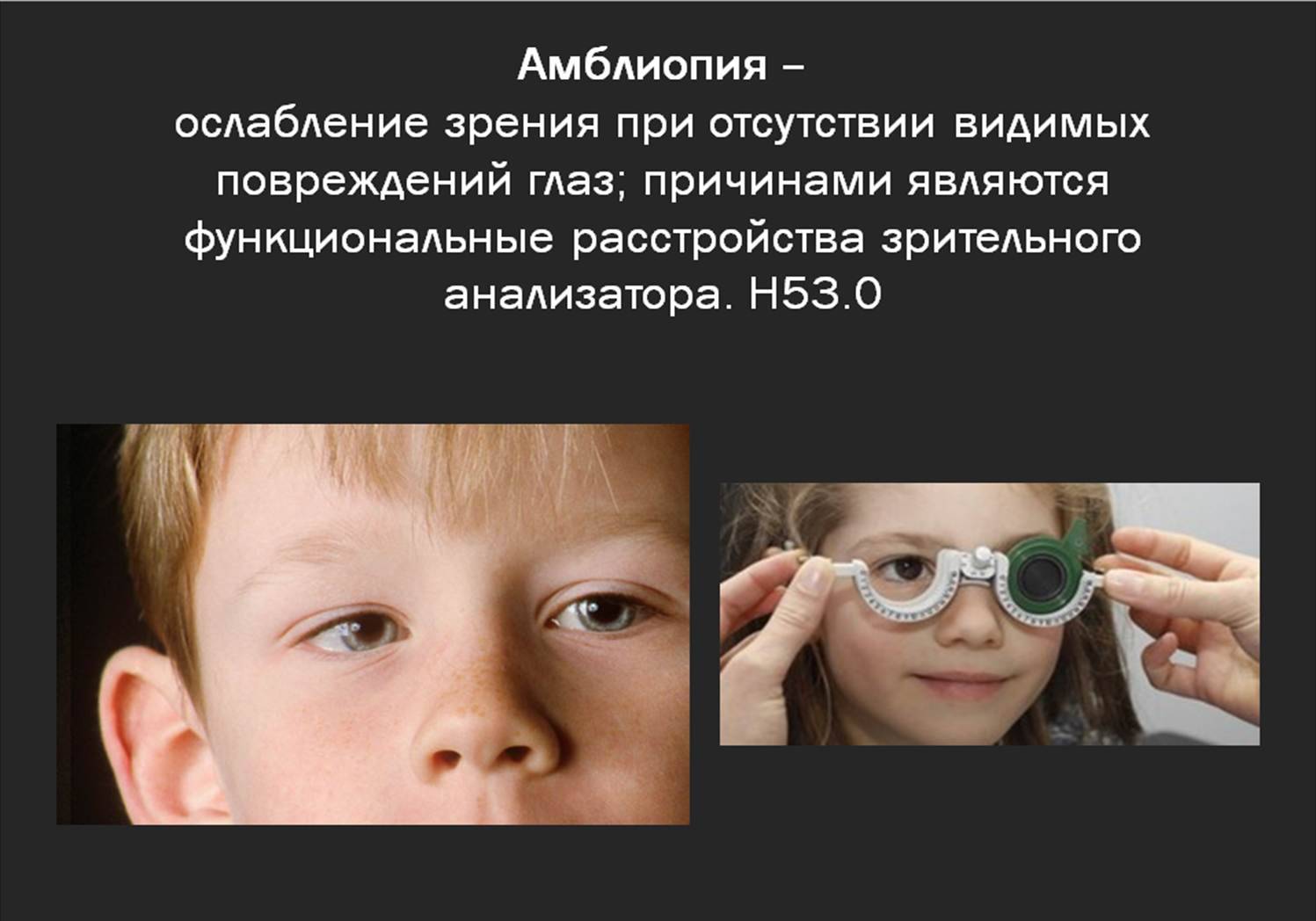 Лазерная коррекция зрения при амблиопии - лечение глаз