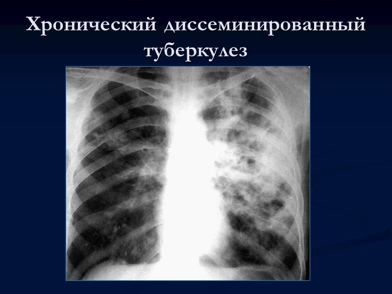 Диагностика и дифференциальная диагностика милиарного туберкулеза легких