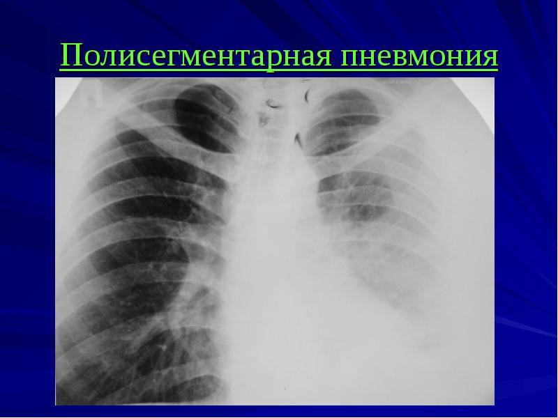 Внутренние болезни - история болезни - внебольничная пневмония