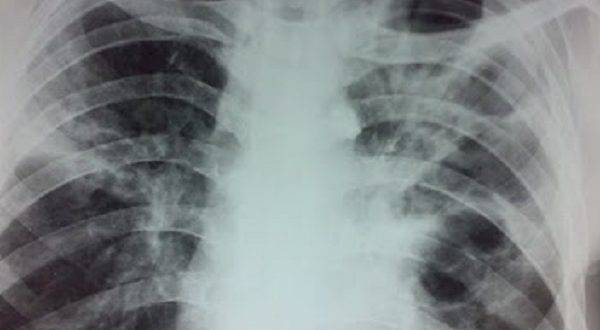 Признаки туберкулеза легких у взрослых
