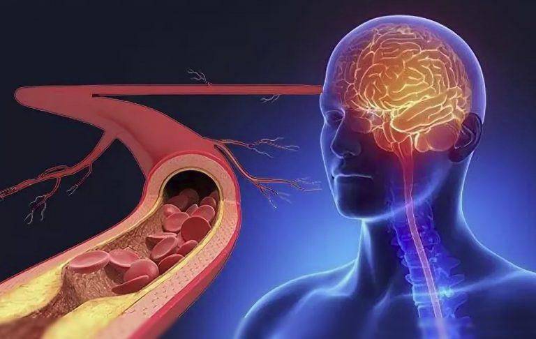 Все возможные причины, симптомы и методы лечения атеросклероза сосудов головного мозга