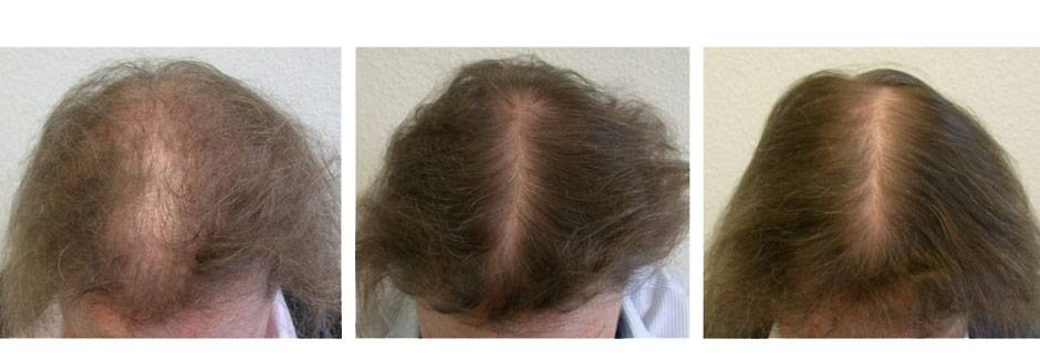 Андрогенное выпадение волос у женщин: действенное лечение