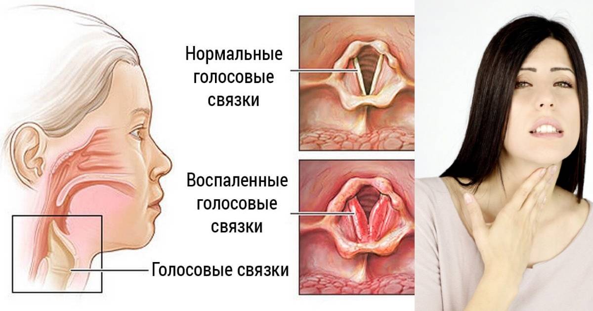 В горле щекочет начинается приступами кашель