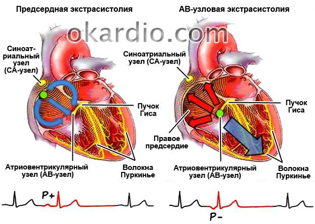 Что такое экстрасистолия сердца, ее лечение и виды