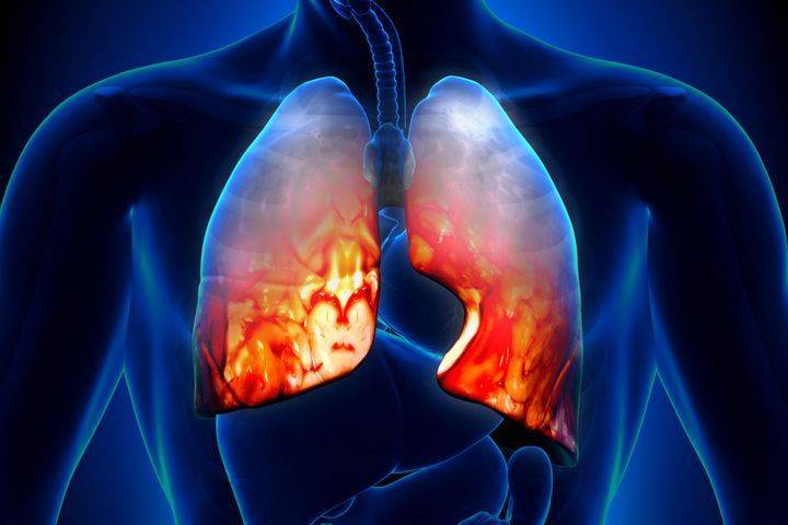 Сколько лечится пневмония (воспаление лёгких)?