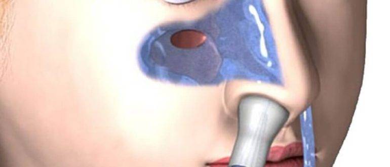 Нарост в носу причины появления и способы удаления полипы в носу лечение без операции