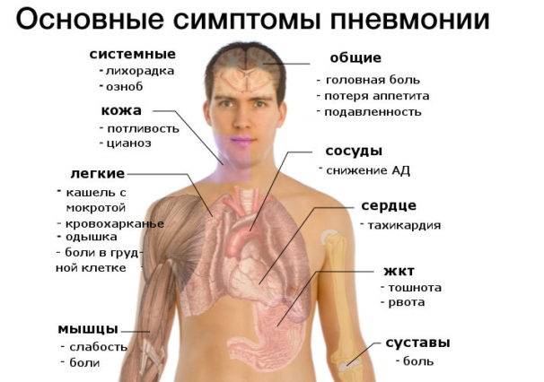 Воспаление легких (пневмония): признаки, симптомы, лечение – напоправку