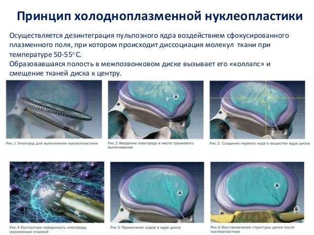 Холодноплазменная нуклеопластика: что это такое и отзывы пациентов | ревматолог | zaslonovgrad.ru