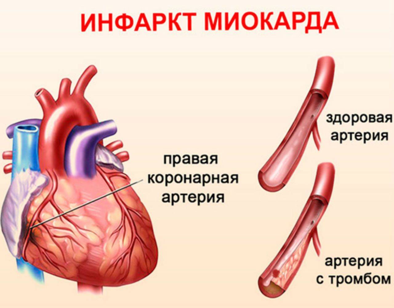 Аритмия и инфаркт: причины появления мерцательной аритмии при или после инфаркта, стенирования, купирование желудочковых