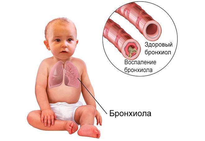 Симптомы и лечение бронхита у грудного ребенка от 1 месяца до года