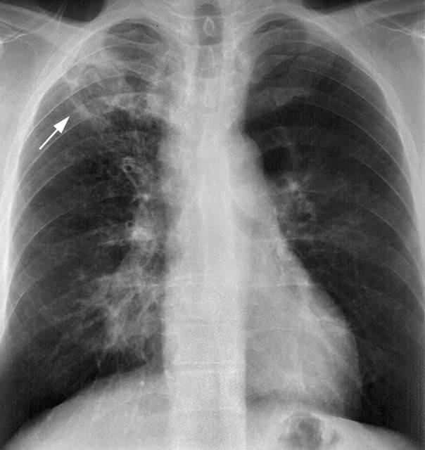 Признаки и симптомы туберкулеза легких: как понять, что ты болен?