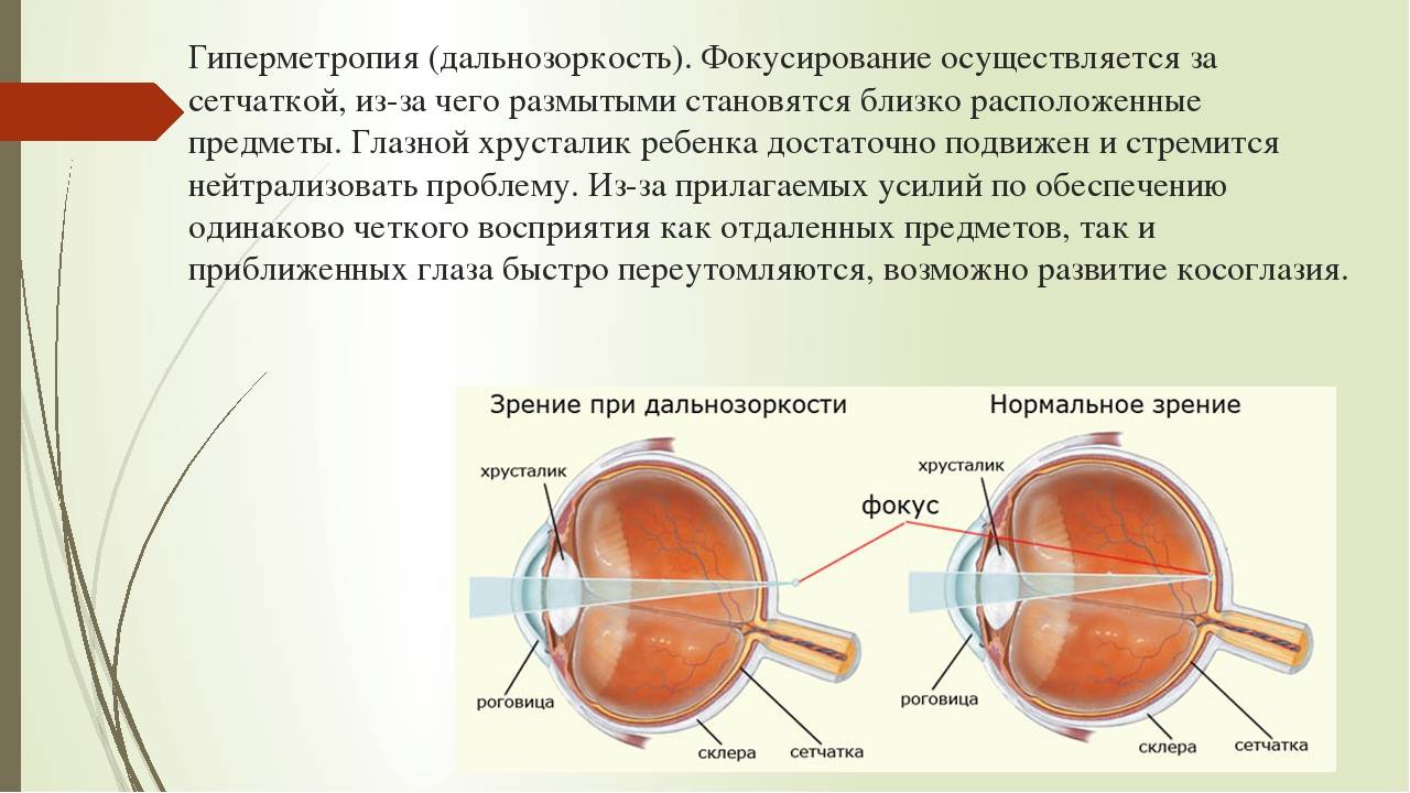 Гиперметропия слабой степени: что это такое, код по мкб 10, дальнозоркость обоих глаз у детей, h52 0, скрытая 1 ст