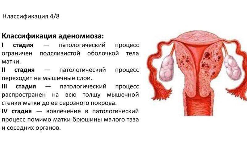 Аденомиоз матки. симптомы и лечение препараты, народные средства при менопаузе, климаксе, беременности
