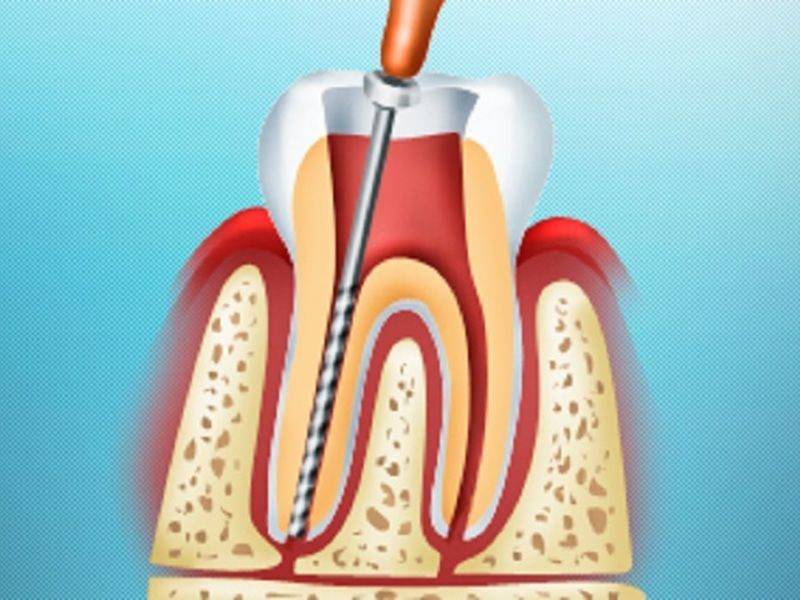 Что такое депульпирование зуба, депульпация (удаление пульпы) зуба при протезировании