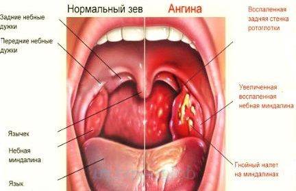 Некротическая ангина: симптомы и лечение