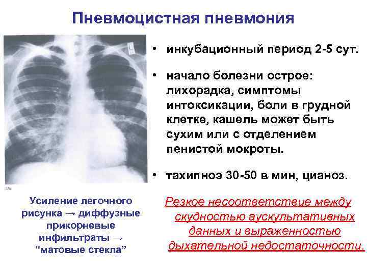 Инфекционная пневмония - инкубационный период у взрослых и детей, вирусное воспаление легких