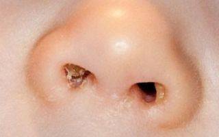 Корки в носу: причины и лечение у взрослых, почему постоянно образуются корочки и кровяные коросты - мази, если сушит слизистую